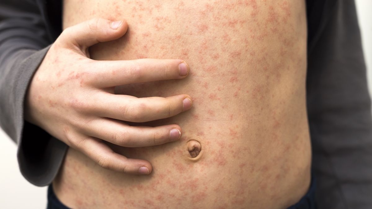 ‘We’re already on the precipice of disaster’: Deadly measles outbreaks could explode across the US in the next 25 years if vaccinations fall, model predicts
