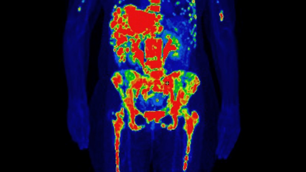 Why cancer rates are rising in young women—and what to do about it
