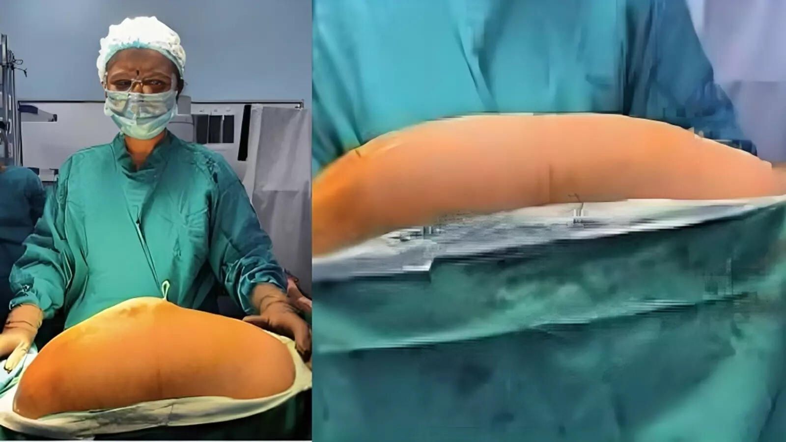 महिला को 8 दिन तक होती रही उल्टियां, पीरियड्स में भी परेशानी… डॉक्टरों ने पेट से निकाली 10 किलो की गा