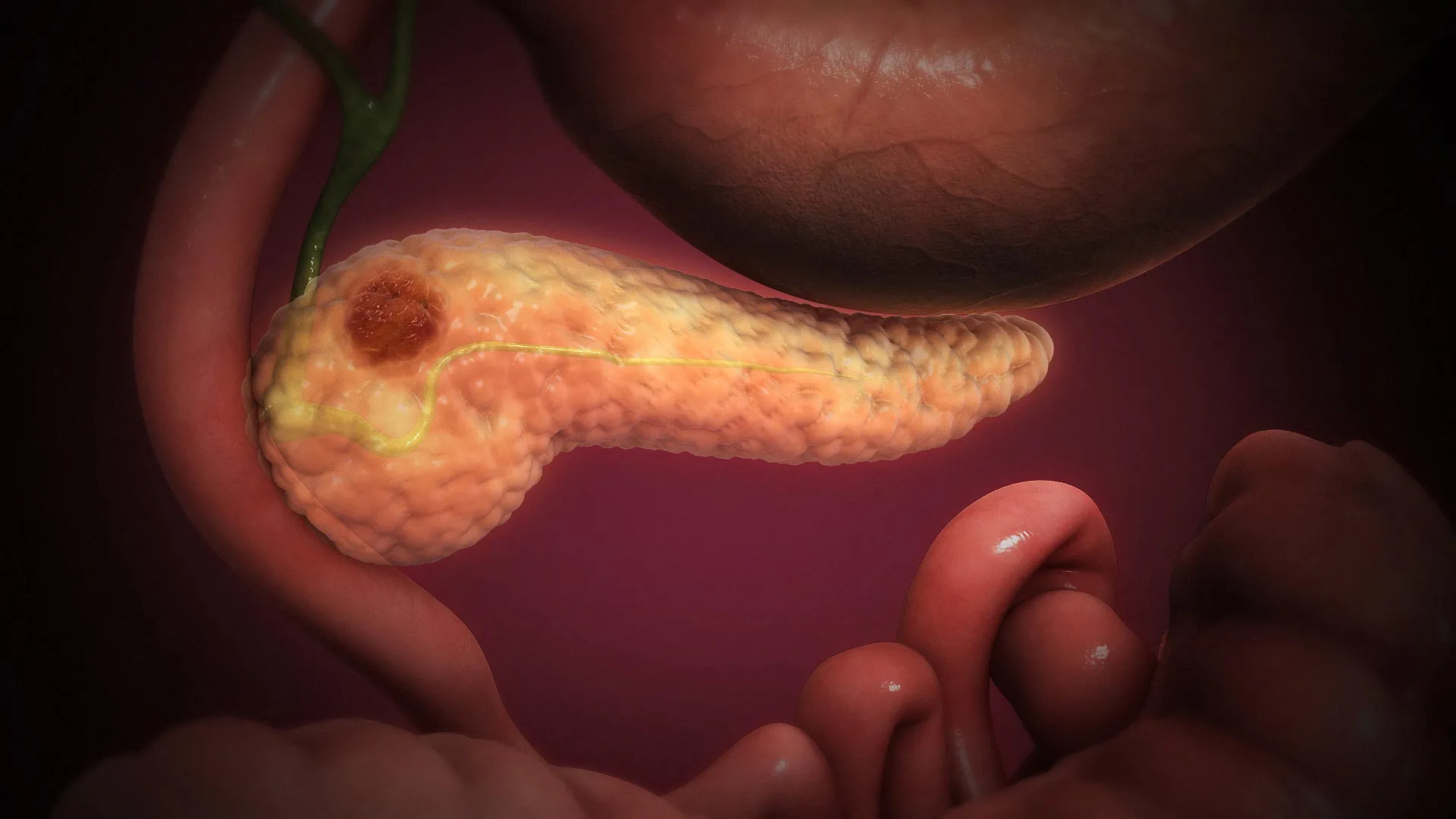 Sweet-smelling molecule halts therapy-resistant pancreatic cancer