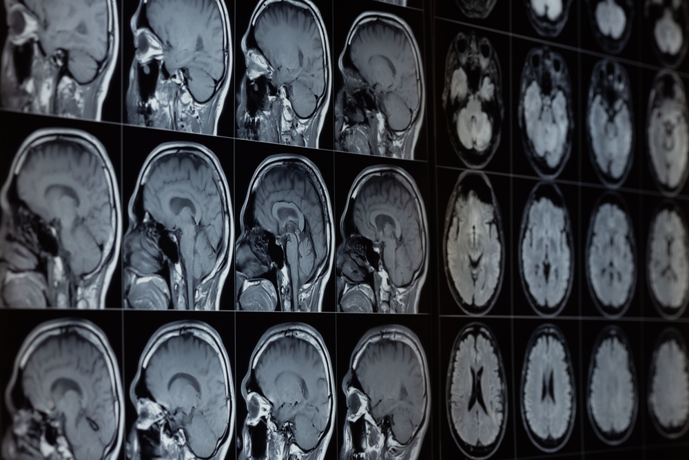 How the Brain Recovers from Running a Marathon Could Lead to Better MS Treatment