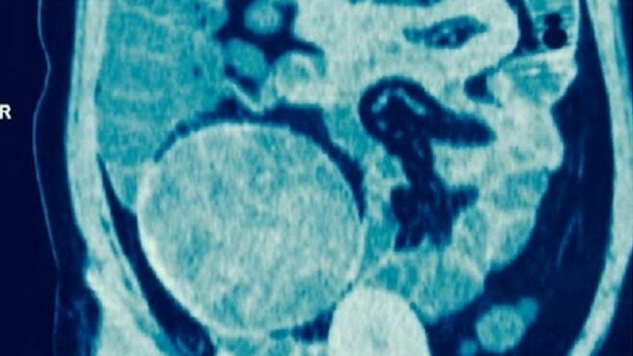 Diagnostic dilemma: Weird lump in woman’s hip was sponge left behind during C-section