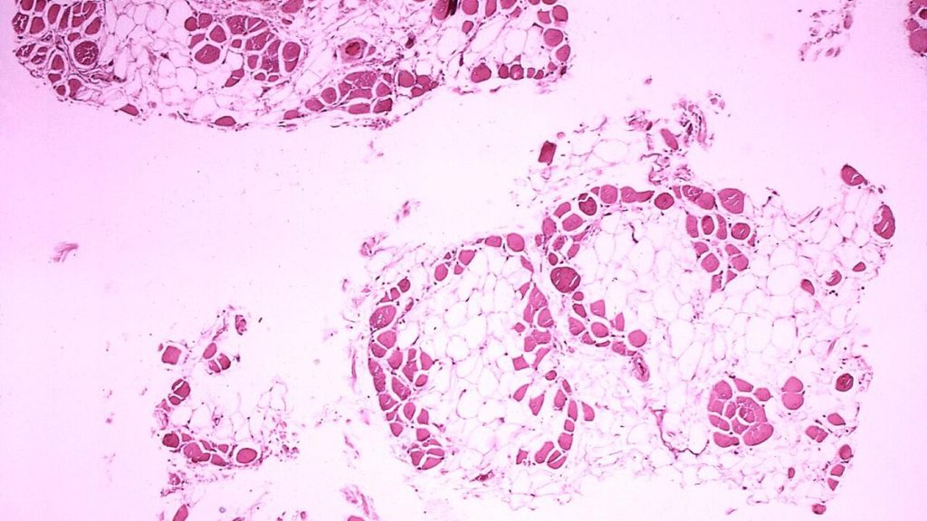Building Awareness: A Lifeline for Rare Diseases in India