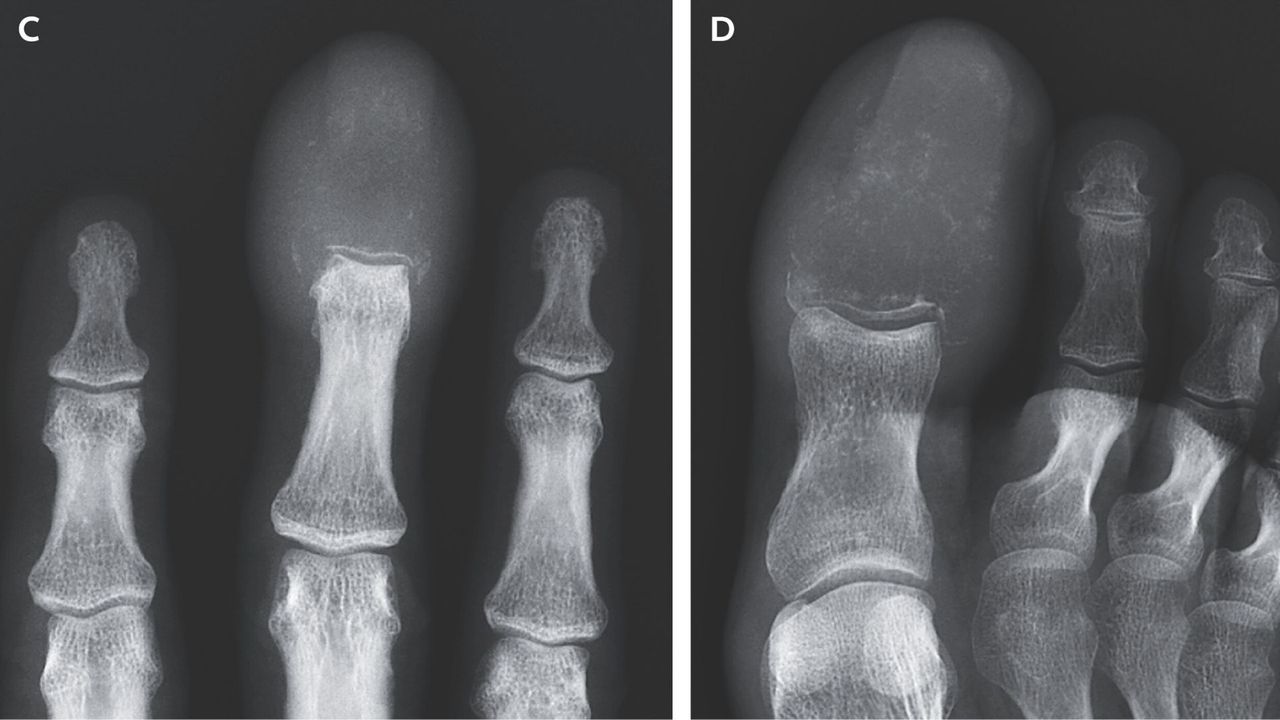 Weird swelling of man’s fingers and toes revealed cancer had ‘completely replaced’ the bones with lesions