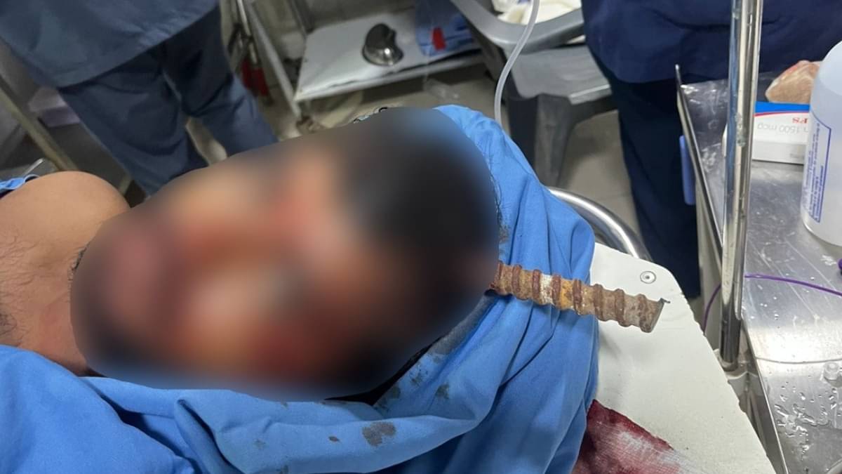 5-Foot Long Iron Rod Fell From Metro Site Piercing Man’s Head, Condition Remains Critical