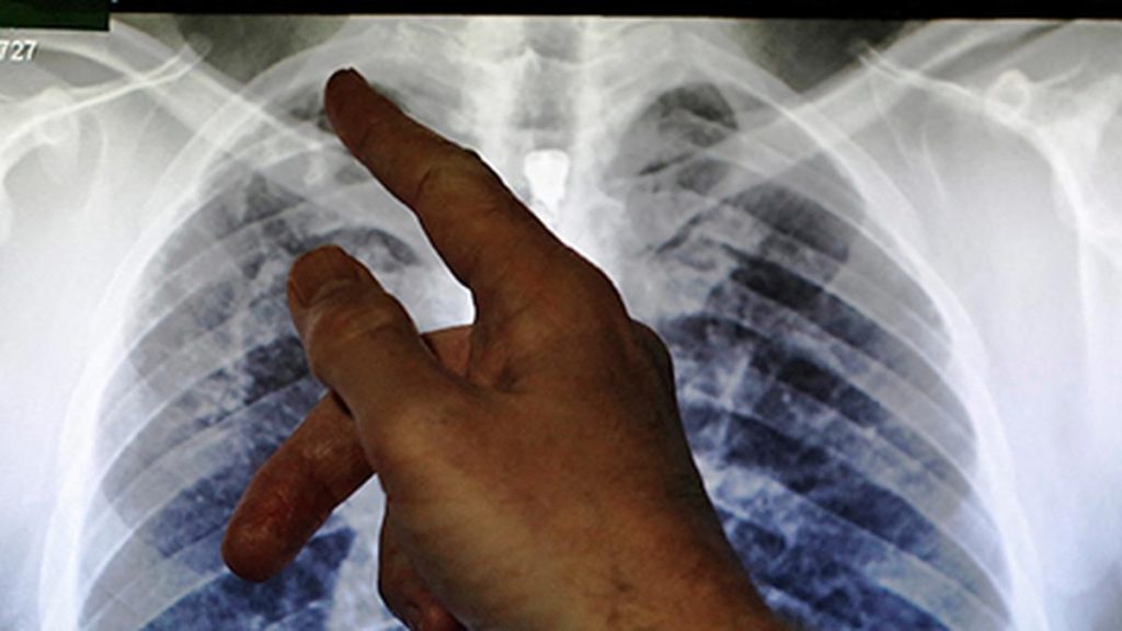 Maharashtra Expands TB Screening via Medical College Family Adoption Initiative