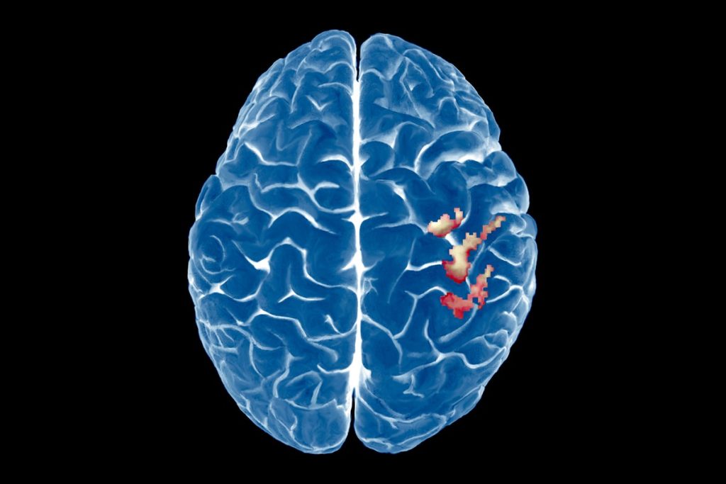 The Brain’s Map of the Body Is Surprisingly Stable—Even after a Limb Is Lost