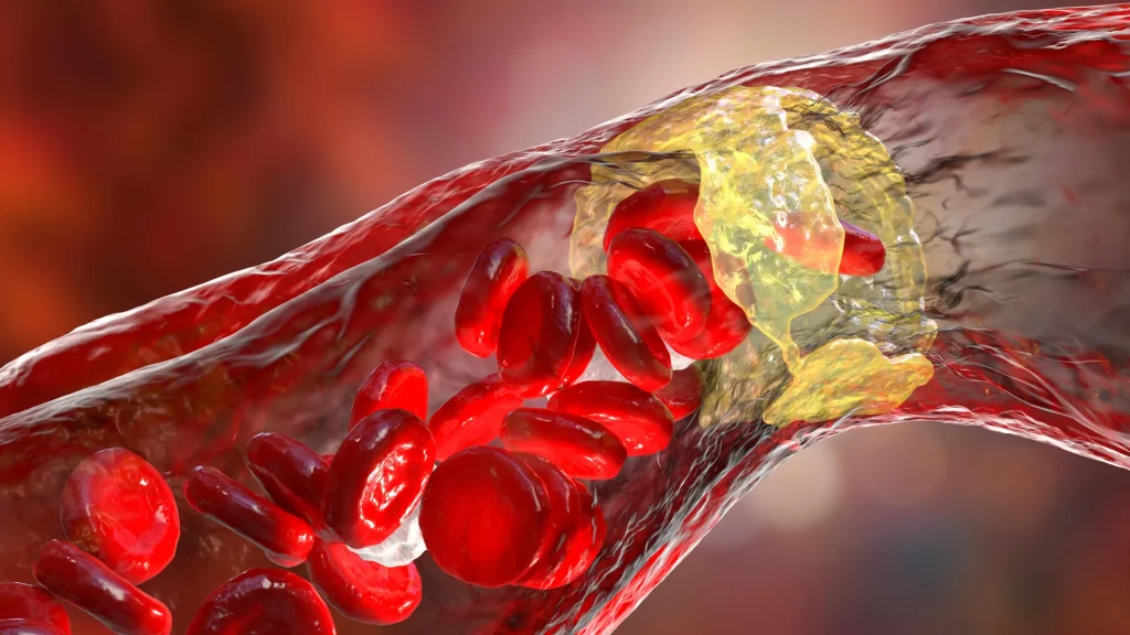 Max-dose statins save lives—here’s why doctors are starting strong